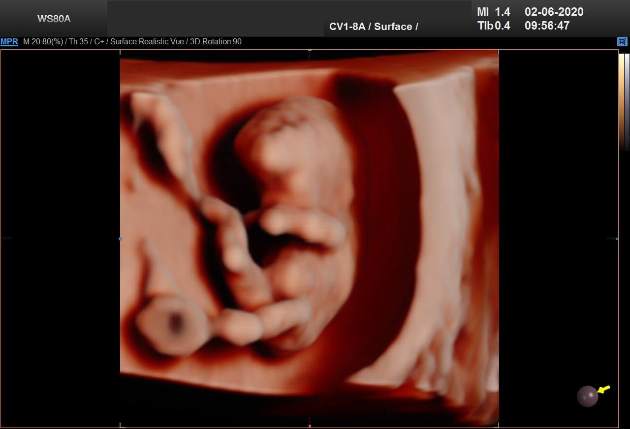 3D ultrazvuk – postavička v profile