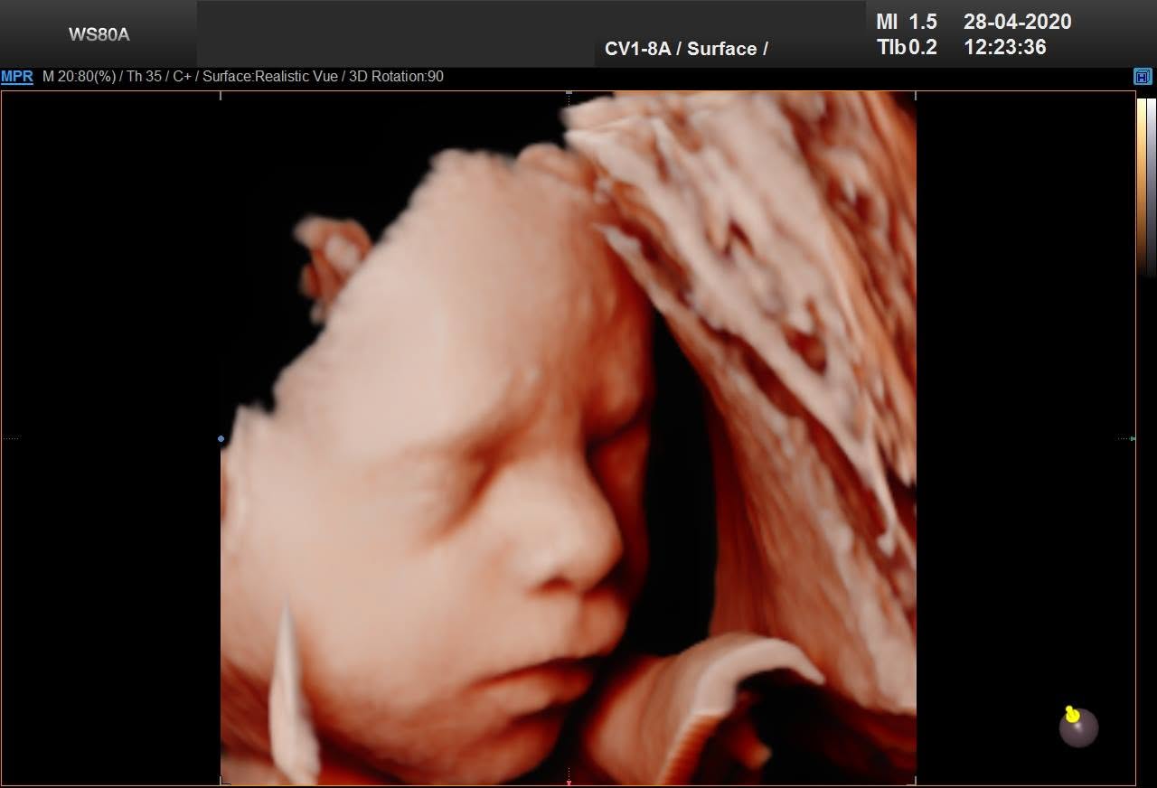 3D ultrazvuk – tvár bábätka v profile