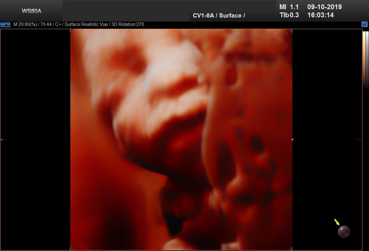 3D ultrazvuk – povrchové zobrazenie