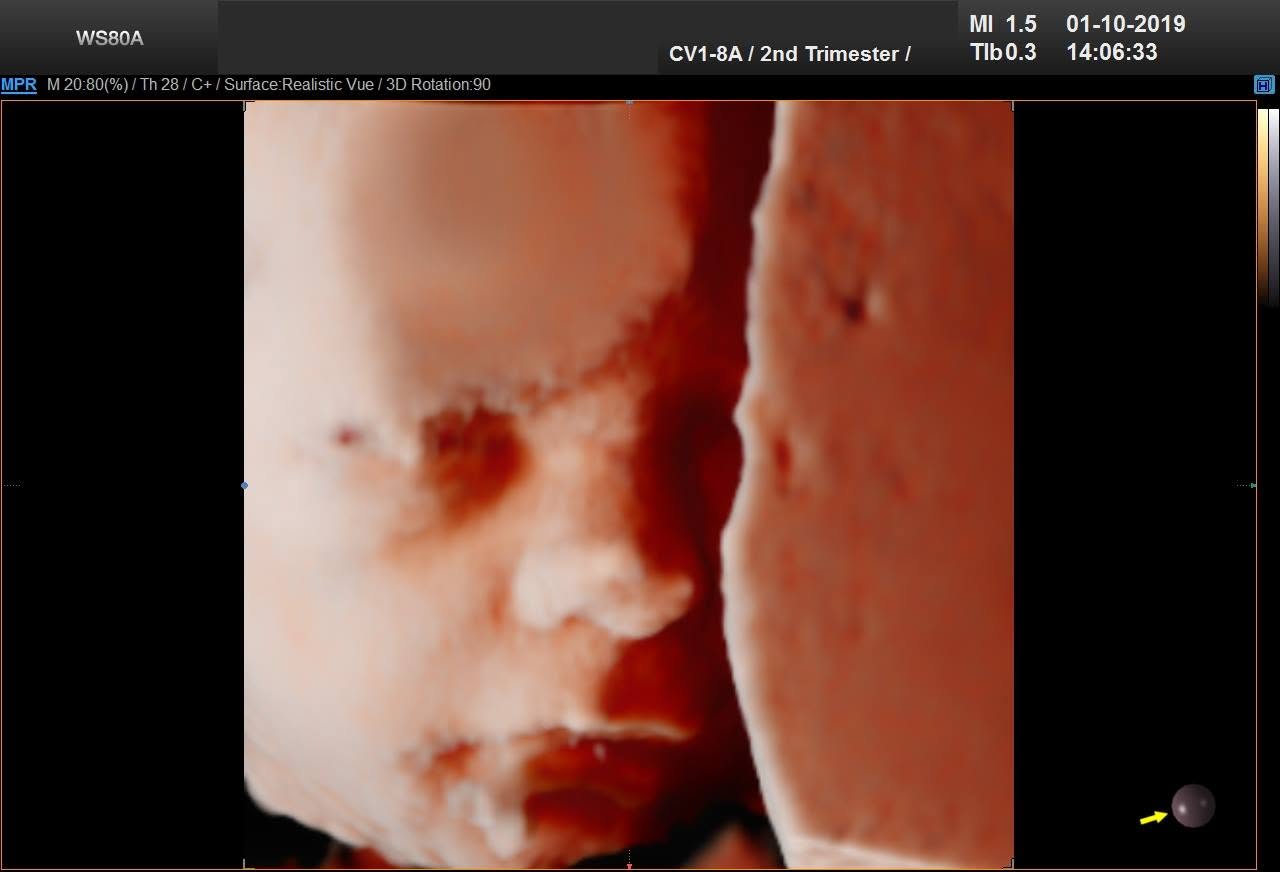3D ultrazvuk – druhý trimester